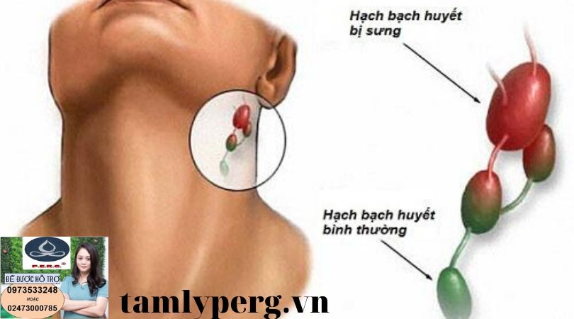 LIỆU PHÁP ĐIỀU TRỊ UNG THƯ BẠCH HUYẾT